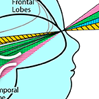 visual field deficits illustration